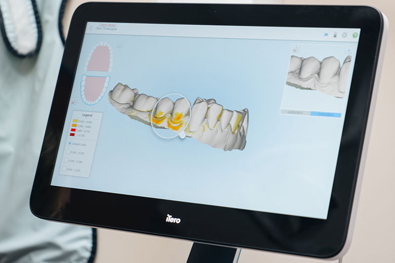 Intra-Oral Camera in 