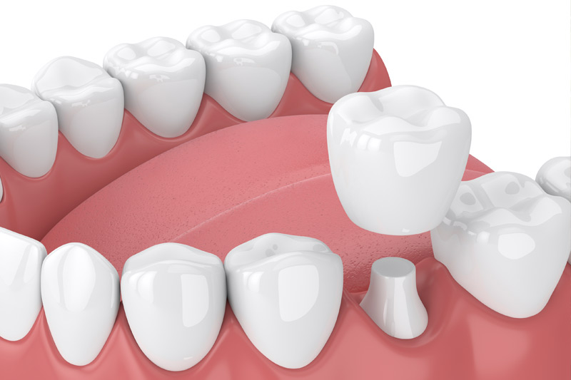 Dental Crowns in Winnipeg