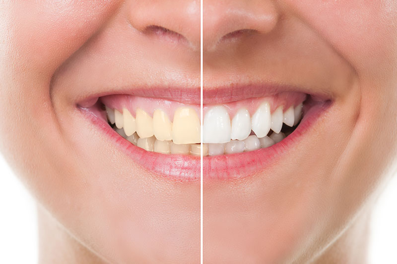 Teeth Whitening in Winnipeg