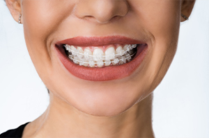 Woman wearing six month smiles clear braces.
